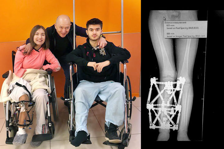 (L-R) Annabel Galova and Lubomir Stoykov with Professor Eidelman during the recovery period at Rambam. Far right: X-ray of a patient's leg following surgery. Photography: Rambam HCC.