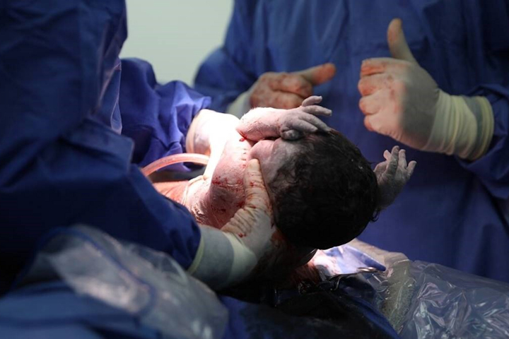 Miracle baby survives complex EXIT procedure. Photo Credit: Rambam HCC.