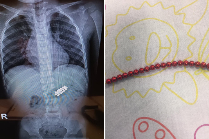 The magnetic beads as seen in the X-ray (L) and after removal (R). 
Photoography: Rambam HCC