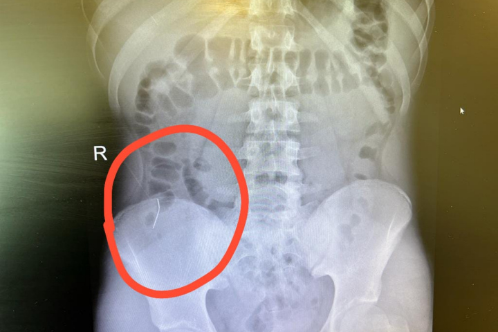 X-ray of the pin located between the small and large intestines. Photography: Rambam HCC