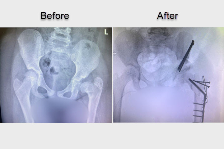 X-rays of Amal before (L) and after (R) surgery. Photography: Rambam HCC.