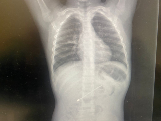 X-ray of the antenna swallowed by the boy