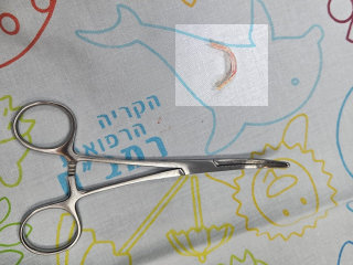 : The piece of plastic stuck at the base of the tongue of the two-year-old toddler