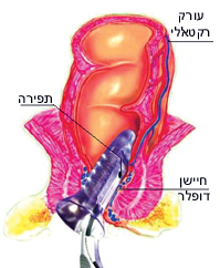 טיפול כירורגי בטחורים בשיטת THD
