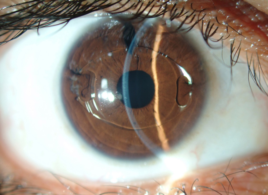 Clinical close-up showing an intraocular lens implant positioned behind the iris