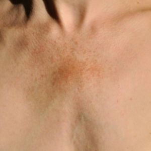 היפרפיגמנטציה – למה היא נגרמת ומה הן השיטות הטובות ביותר לטיפול?